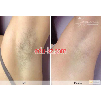 Лазерная эпиляция Эстетическое удаление волос на Гуляева - на портале beautyby.su
